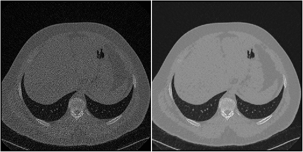 Pair of noisy low-dose and high quality regular-dose CT images of the chest