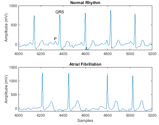 Two plots showing electrocardiogram recordings of a healthy heart and a heart experiencing atrial fibrillation