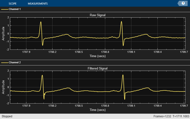 Outlier Removal Techniques with ECG Signals