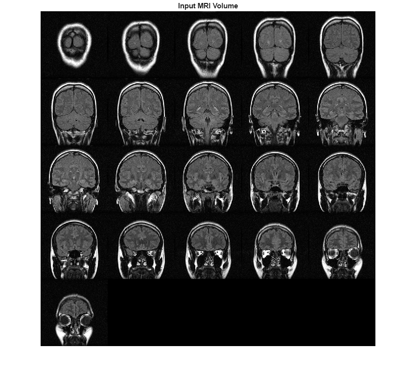 Figure contains an axes object. The hidden axes object with title Input MRI Volume contains an object of type image.