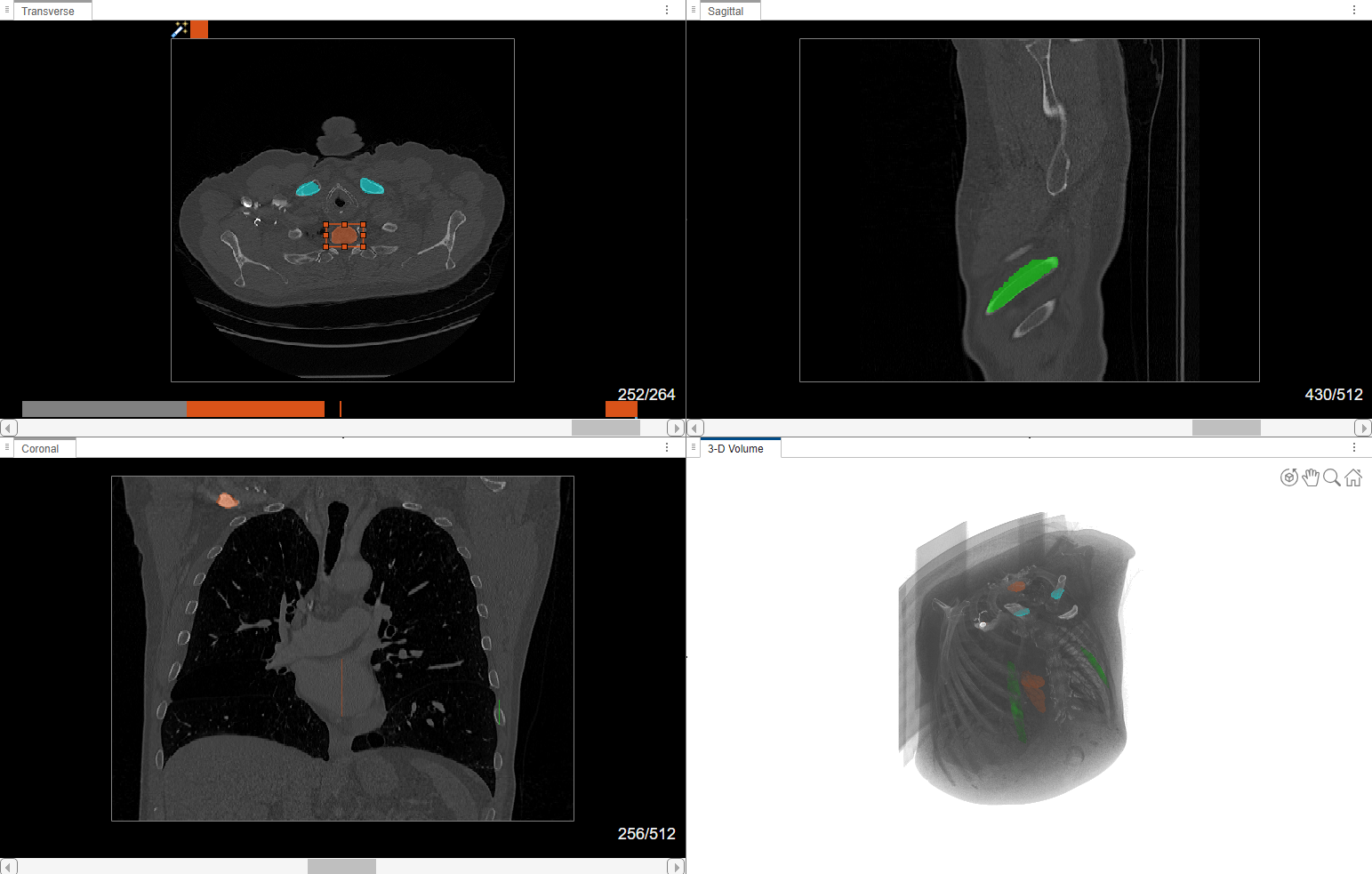 MedSAM in Medical Image Labeler
